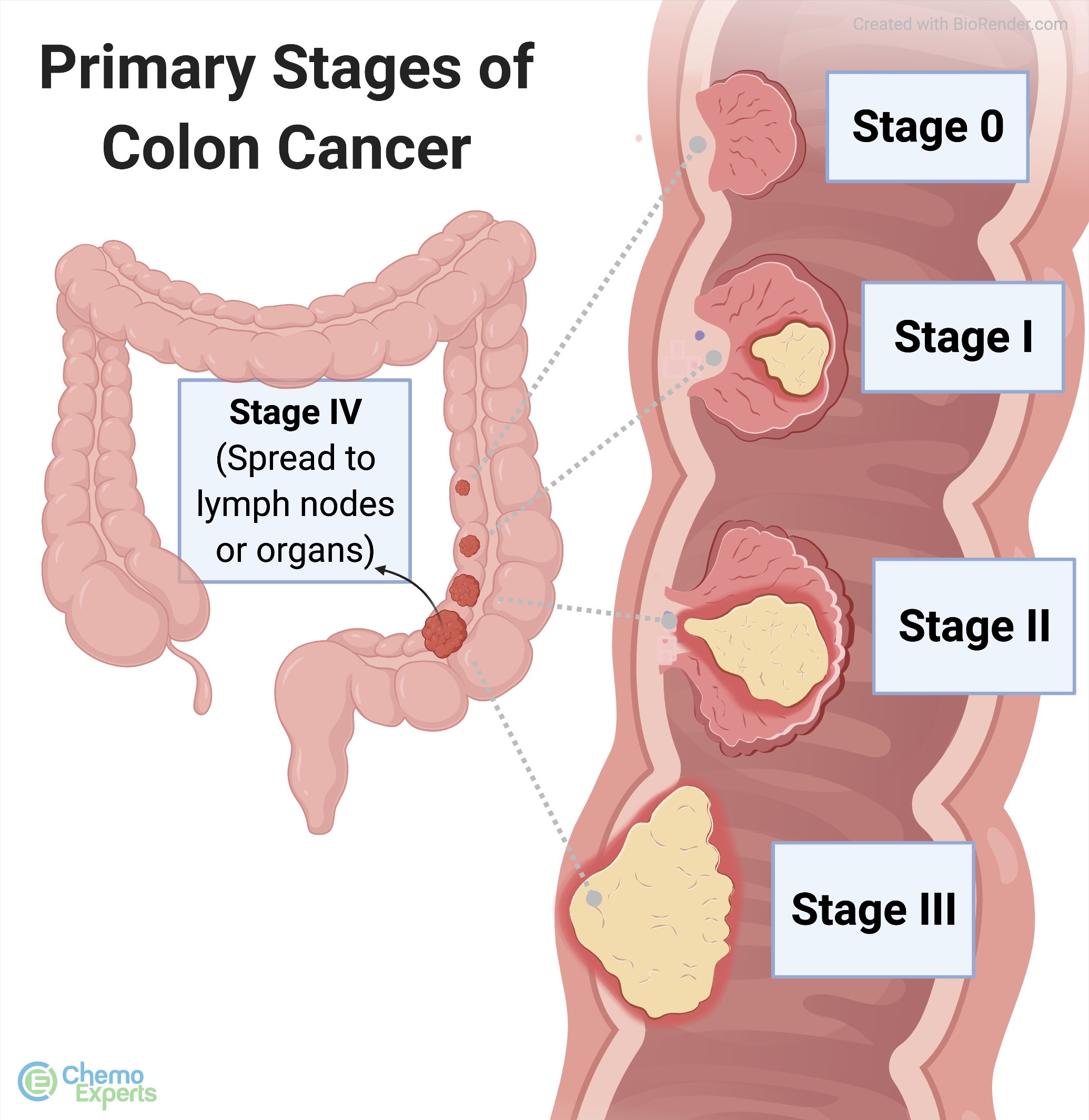 Colon Cancer Treatment | Chemoexperts
