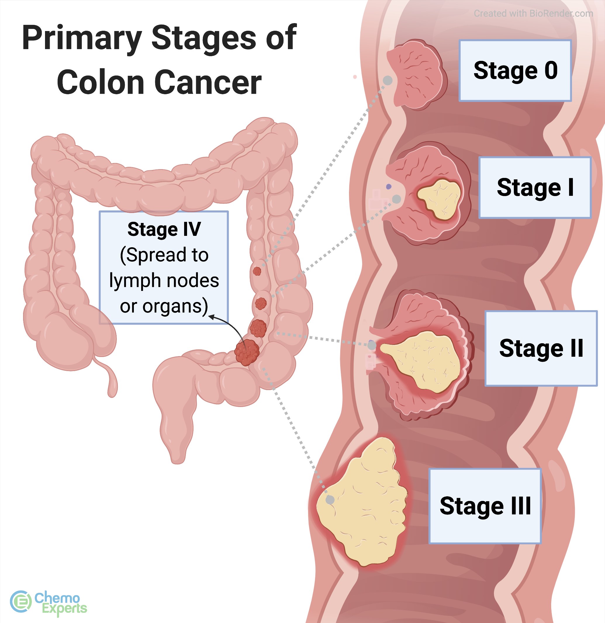 colon cancer stage 0